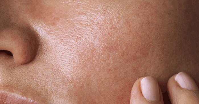 چطور پوستی سالم داشته باشیم؟