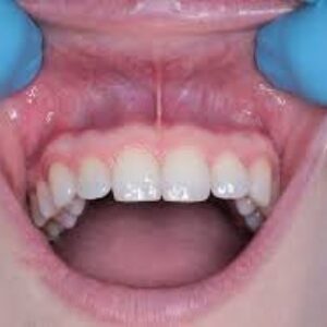 چشم انداز فرد مبتلا به سرطان لثه چیست؟