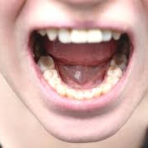 چگونه متوجه می شوید که سرطان دهان گسترش یافته است؟