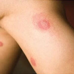 عفونت پوستی کاندیدا چیست؟