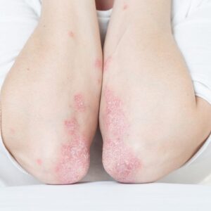 تشخیص و درمان آرتریت پسوریاتیک