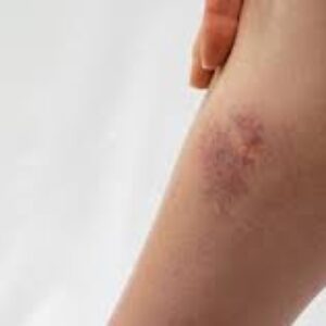 کاندیدیازیس پوستی چگونه به نظر میرسد؟