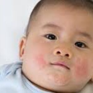 ایمپتیگو یا زرد زخم چیست؟