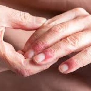 سوال های مرتبط با آرتریت التهابی پسوریاتیک