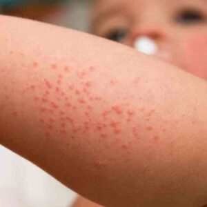 چه کسانی در معرض خطر ابتلا به زرد زخم هستند؟