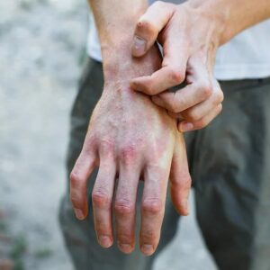 آرتریت پسوریاتیک و پسوریازیس