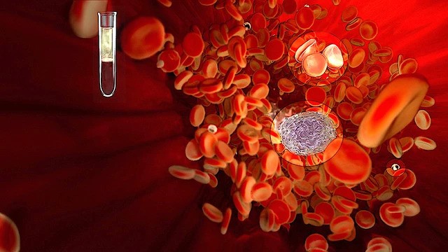 کم‌خونی به‌عنوان یکی از عوارض HIV